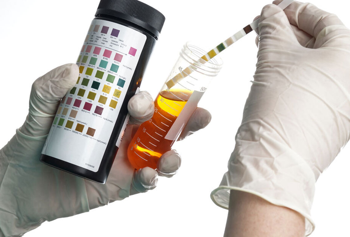 Dipstick Urinalysis Definition At Eugene Johnson Blog